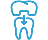 Veneers