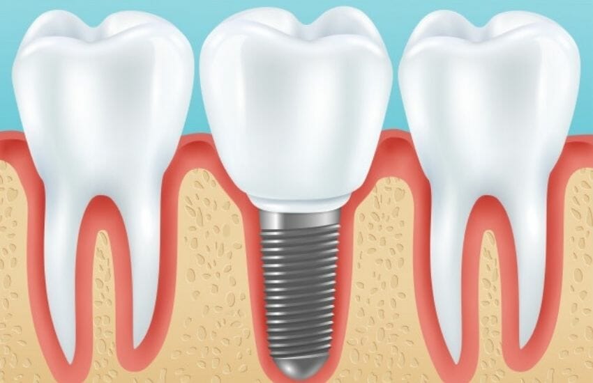 Tooth Extraction in Dallas TX