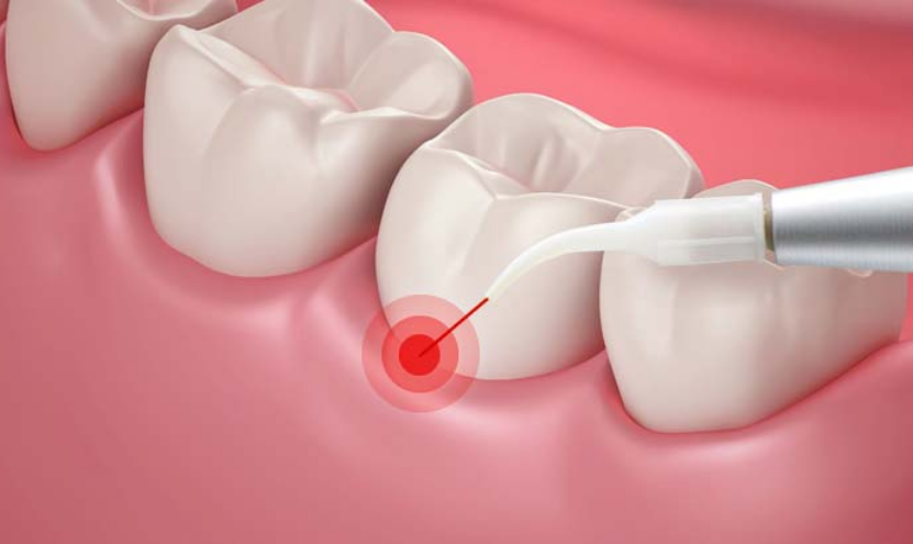 Laser gum treatment illustration at Bleu Dentistry in Oak Lawn, Dallas