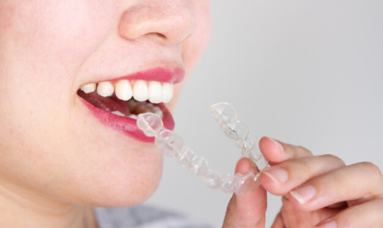 5 Reasons To Choose Invisalign® As Your Orthodontic Treatment Option